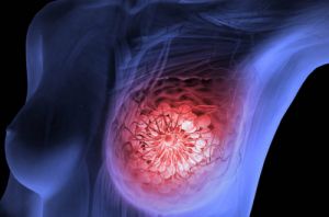 Cancer Services - Cancer Types - Breast Cancer - Introduction Cancer Services - Cancer Types - Breast Cancer - Introduction